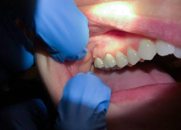 Best Emergency Wisdom Teeth Removal in Hoxie, AR